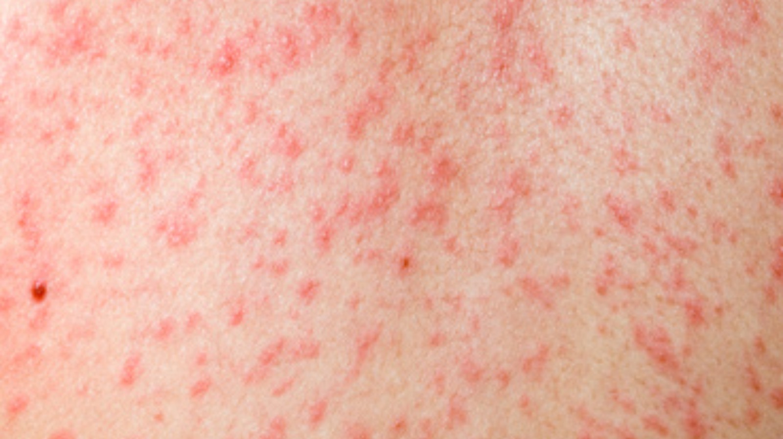 Rubella (German measles)